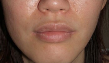 症例3　上・下口唇（口びる）縮小術 手術前
