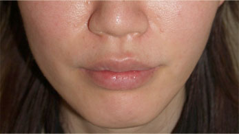 症例3　上・下口唇（口びる）縮小術 手術後
