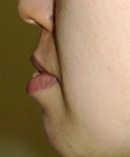 症例4　下口唇（口びる）縮小術 手術前