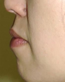 症例4　下口唇（口びる）縮小術 手術後