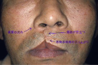 症例7　口唇裂口蓋裂術後修正手術 手術前