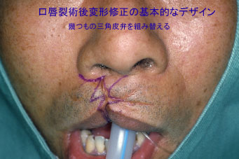 症例7　口唇裂口蓋裂術後修正手術 手術デザイン