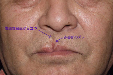 症例8　口唇裂術後修正手術 手術前