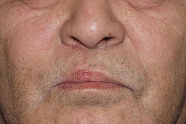 症例8　口唇裂術後修正手術  手術後