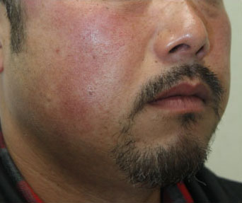 症例10　フォトフェイシャル（赤ら顔、毛細血管拡張） 治療前