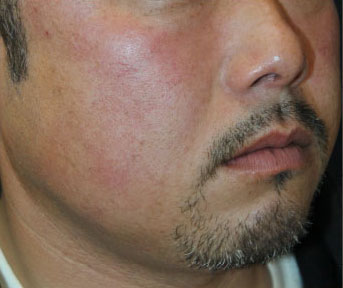 症例10　フォトフェイシャル（赤ら顔、毛細血管拡張） 治療中10ヶ月経過