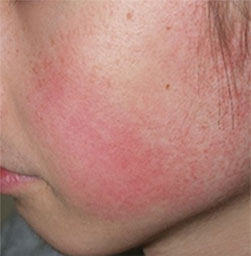 症例4　フォトフェイシャル（赤ら顔・肌のざらざら感） 治療前