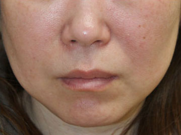 症例7　フォトフェイシャル（赤ら顔・肝斑） 治療前