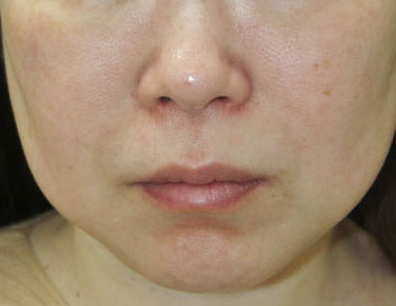 症例7　フォトフェイシャル（赤ら顔・肝斑） 治療後1年経過
