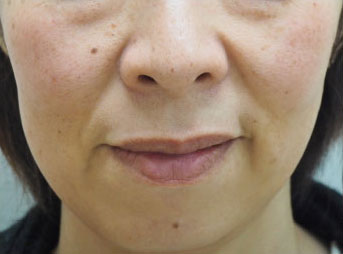 症例9　フォトフェイシャル（頬全体のそばかす、しみ） 治療前