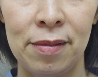 症例9　フォトフェイシャル（頬全体のそばかす、しみ） 治療後