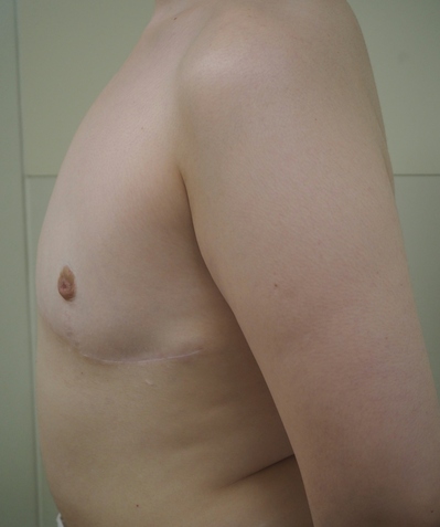 乳房切除　男性化希望2c後.JPG