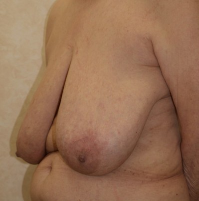 乳房縮小　.jpg