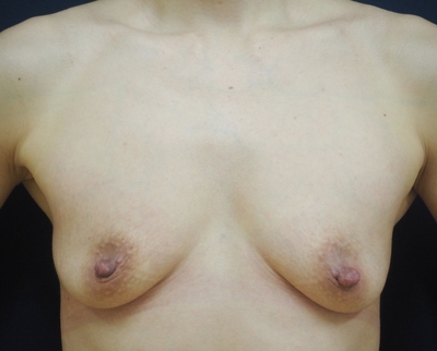 豊胸36a.JPG