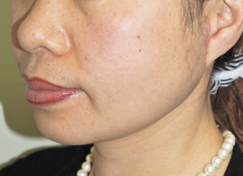 症例1　下顎形成術・エラ削り 手術後