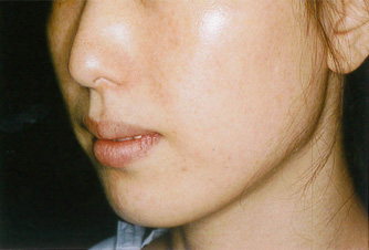 症例2　下顎形成術・エラ削り 手術前