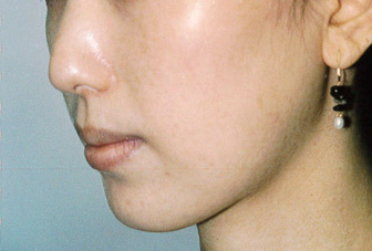 症例2　下顎形成術・エラ削り 手術後
