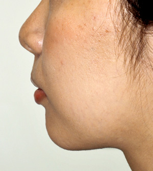 症例1　あごへのヒアルロン酸注入 施術前