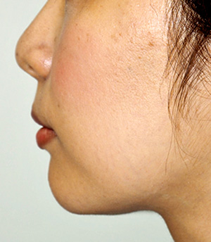 症例1　あごへのヒアルロン酸注入 施術後