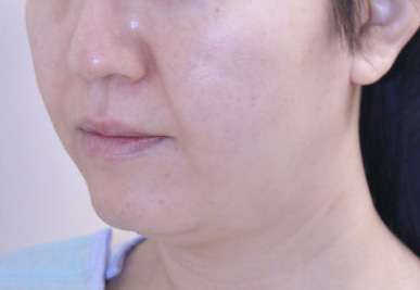 症例6　フェイスリフト（頬・あご）・頬、あごの脂肪吸引 手術前