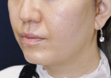 症例6　フェイスリフト（頬・あご）・頬、あごの脂肪吸引 手術後