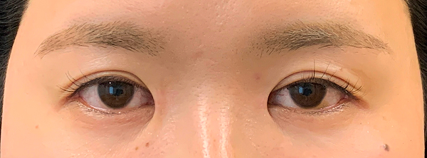 症例36　他院目頭切開術後 手術後