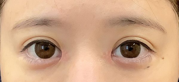 症例39　他院目頭切開術後 手術後