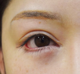 症例10　他院下眼瞼下制（垂れ目形成、グラマラスライン形成）術後 手術前