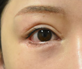 症例10　他院下眼瞼下制（垂れ目形成、グラマラスライン形成）術後 手術後