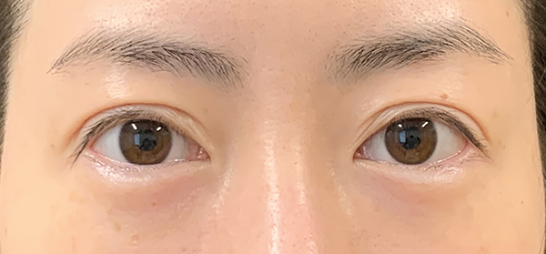 症例1　二重切開法の他院修正 手術前