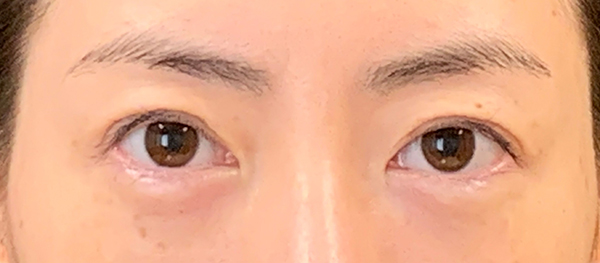 症例1　二重切開法の他院修正 手術後