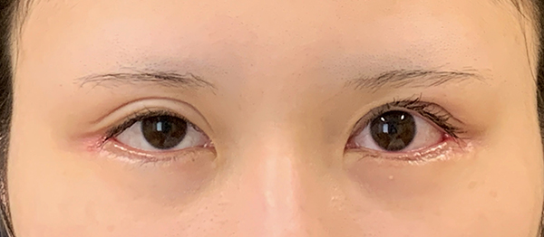 症例31　二重切開法の他院修正 手術前