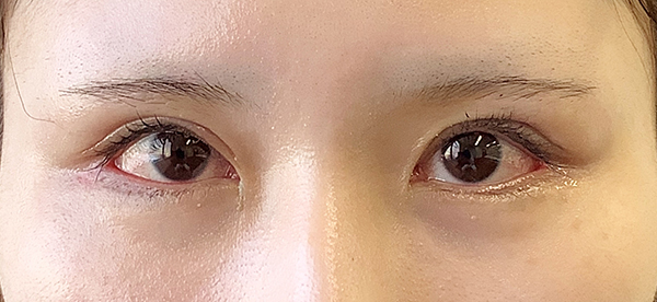 症例31　二重切開法の他院修正 手術後