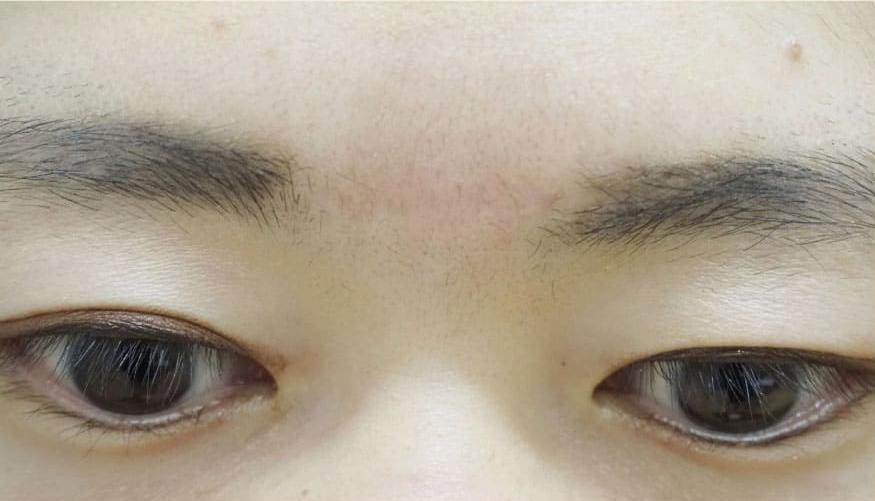 症例3　眉間傷跡修正 手術後