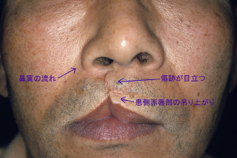 症例1　口唇裂口蓋裂術後修正手術 手術前