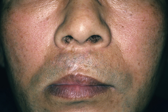 症例1　口唇裂口蓋裂術後修正手術 手術後1年