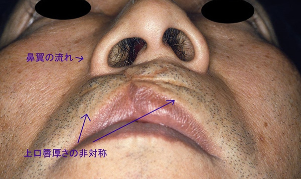 症例1　口唇裂口蓋裂術後修正手術 手術前
