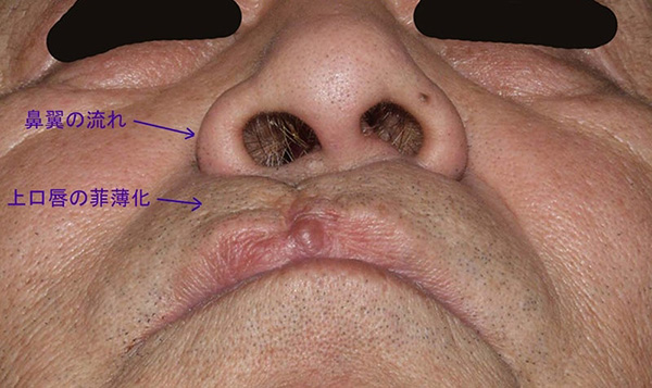 症例2　口唇裂術後修正手術 手術前