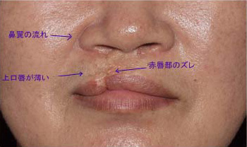症例3　口唇裂術後修正手術 手術前