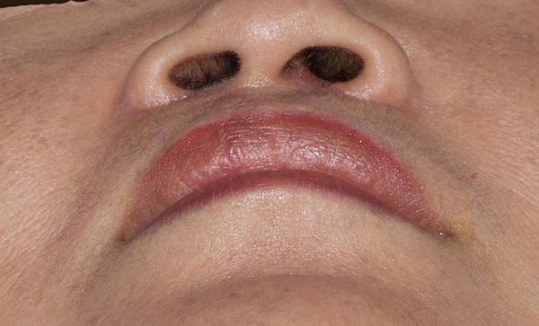 症例3　口唇裂術後修正手術 手術後