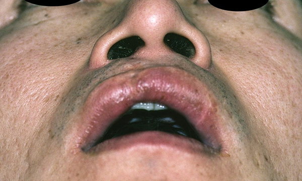 症例4　口唇裂術後修正手術 手術前