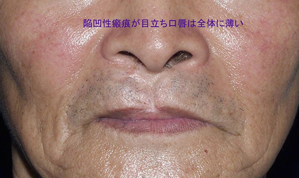 症例5　口唇裂口蓋裂術後修正手術 手術前