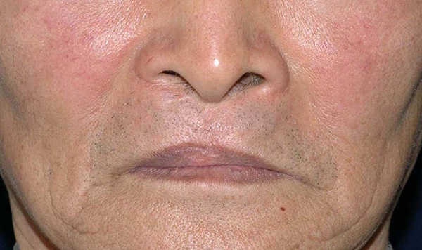 症例5　口唇裂口蓋裂術後修正手術 手術後