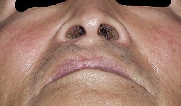 症例5　口唇裂口蓋裂術後修正手術 手術前