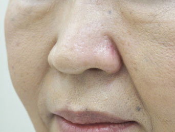 症例4　ほくろ除去（高周波電気分解） 手術後