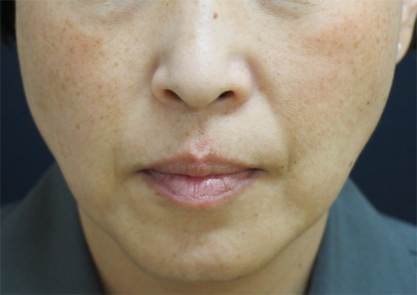 症例6　レーザートーニング（頬全体のそばかす、肝斑） 治療前