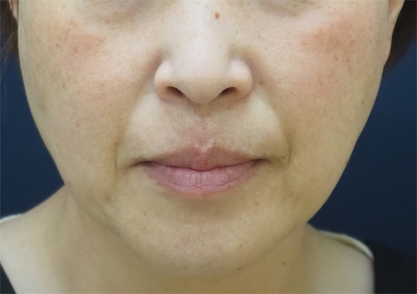 症例6　レーザートーニング（頬全体のそばかす、肝斑） 治療後