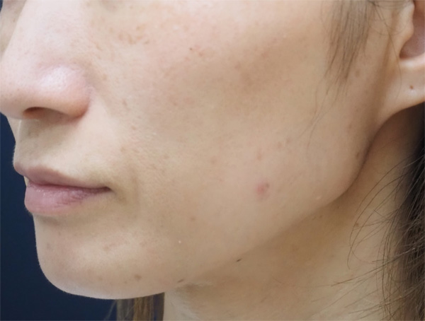 症例12　フォトフェイシャル（老人性色素斑）治療後