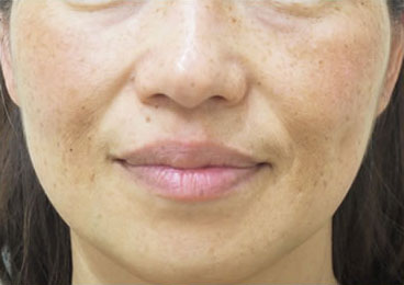 症例1　頬の肝斑、そばかす、老人性色素斑 治療前