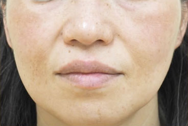 症例1　頬の肝斑、そばかす、老人性色素斑 治療後